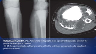 OSTEOBLASTIC VARIETY. (A) AP and lateral radiographs show a purely osteosclerotic lesion of the
proximal metaphysis of the tibia
(B) CT shows mineralization of tumor matrix within the soft tissue component and a spiculated
periosteal reaction
 