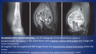 TELANGIECTATIC OSTEOSARCOMA. (A) AP radiograph of the distal femur shows a
predominantly lytic lesion in the distal femur with irregular cortical destruction and a large soft
tissue component,
(B) Sagittal T2W fat suppressed MR image shows the characteristic blood-fluid levels within the
tumor,
(C) On contrast enhancement, marked peripheral and septal enhancement is seen
 