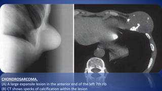 CHONDROSARCOMA.
(A) A large expansile lesion in the anterior end of the left 7th rib
(B) CT shows specks of calcification within the lesion
 