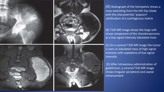 (A) Radiograph of the hemipelvis shows a
mass extending from the left iliac blade
with the characteristic ‘popcorn’
calcification of a cartilaginous matrix
(B) T1W MR image shows the large soft
tissue component of the chondrosarcoma
as a low signal intensity lobulated mass
(C) On a coronal T2W MR image the tumor
is seen as lobulated mass of high signal
intensity with septations of low signal
intensity
(D) After intravenous administration of
gadolinium, a coronal T1W MR image
shows irregular peripheral and septal
enhancement
 
