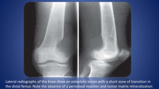 Lateral radiographs of the knee show an osteolytic lesion with a short zone of transition in
the distal femur. Note the absence of a periosteal reaction and tumor matrix mineralization
 