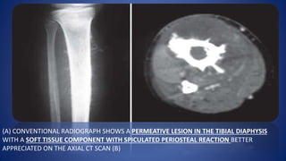 (A) CONVENTIONAL RADIOGRAPH SHOWS A PERMEATIVE LESION IN THE TIBIAL DIAPHYSIS
WITH A SOFT TISSUE COMPONENT WITH SPICULATED PERIOSTEAL REACTION BETTER
APPRECIATED ON THE AXIAL CT SCAN (B)
 