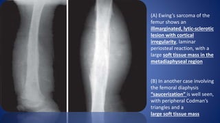 (A) Ewing’s sarcoma of the
femur shows an
illmarginated, lytic-sclerotic
lesion with cortical
irregularity, laminar
periosteal reaction, with a
large soft tissue mass in the
metadiaphyseal region
(B) In another case involving
the femoral diaphysis
“saucerization” is well seen,
with peripheral Codman’s
triangles and a
large soft tissue mass
 