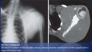 (A) Plain radiograph
(B) Axial CT section of left shoulder shows a dense sclerotic involvement of the scapula with a
large soft tissue mass
 