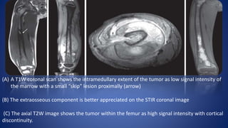 (A) A T1W coronal scan shows the intramedullary extent of the tumor as low signal intensity of
the marrow with a small “skip” lesion proximally (arrow)
(B) The extraosseous component is better appreciated on the STIR coronal image
(C) The axial T2W image shows the tumor within the femur as high signal intensity with cortical
discontinuity.
 
