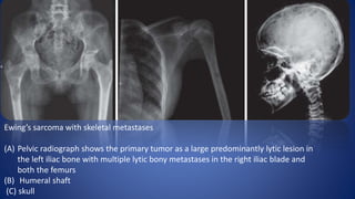 Ewing’s sarcoma with skeletal metastases
(A) Pelvic radiograph shows the primary tumor as a large predominantly lytic lesion in
the left iliac bone with multiple lytic bony metastases in the right iliac blade and
both the femurs
(B) Humeral shaft
(C) skull
 