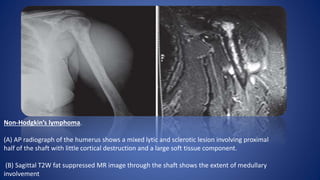 Non-Hodgkin’s lymphoma.
(A) AP radiograph of the humerus shows a mixed lytic and sclerotic lesion involving proximal
half of the shaft with little cortical destruction and a large soft tissue component.
(B) Sagittal T2W fat suppressed MR image through the shaft shows the extent of medullary
involvement
 
