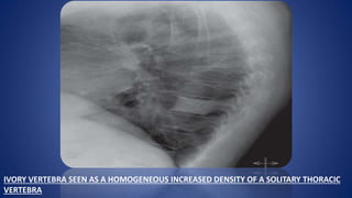 IVORY VERTEBRA SEEN AS A HOMOGENEOUS INCREASED DENSITY OF A SOLITARY THORACIC
VERTEBRA
 