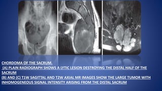 CHORDOMA OF THE SACRUM.
(A) PLAIN RADIOGRAPH SHOWS A LYTIC LESION DESTROYING THE DISTAL HALF OF THE
SACRUM
(B) AND (C) T1W SAGITTAL AND T2W AXIAL MR IMAGES SHOW THE LARGE TUMOR WITH
INHOMOGENEOUS SIGNAL INTENSITY ARISING FROM THE DISTAL SACRUM
 