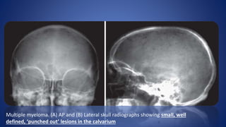 Multiple myeloma. (A) AP and (B) Lateral skull radiographs showing small, well
defined, ‘punched out’ lesions in the calvarium
 