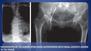 RADIOGRAPHS OF THE DORSAL SPINE SHOW OSTEOPOROSIS WITH SMALL DISCRETE LESIONS
IN THE FEMUR .
 