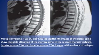 Multiple myeloma. T1W (A) and T2W (B) sagittal MR images of the dorsal spine
show complete alteration of the marrow signal in the seventh thoracic vertebra,
hypointense on T1W and hyperintense on T2W images, with evidence of collapse.
 