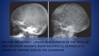 SKELETAL METASTASES. LATERAL RADIOGRAPHS OF THE SKULL OF
TWO DIFFERENT PATIENTS SHOW MULTIPLE ILL-DEFINED LYTIC
LESIONS OF VARYING SIZES IN THE CALVARIUM
 