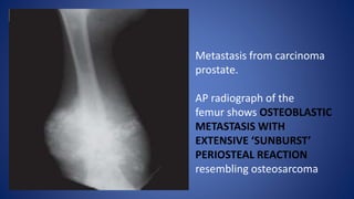 Metastasis from carcinoma
prostate.
AP radiograph of the
femur shows OSTEOBLASTIC
METASTASIS WITH
EXTENSIVE ‘SUNBURST’
PERIOSTEAL REACTION
resembling osteosarcoma
 