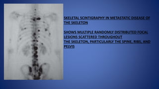 SKELETAL SCINTIGRAPHY IN METASTATIC DISEASE OF
THE SKELETON
SHOWS MULTIPLE RANDOMLY DISTRIBUTED FOCAL
LESIONS SCATTERED THROUGHOUT
THE SKELETON, PARTICULARLY THE SPINE, RIBS, AND
PELVIS
 
