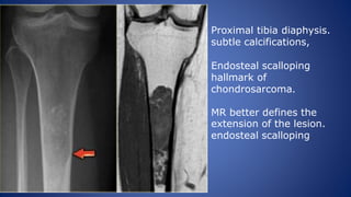 Proximal tibia diaphysis.
subtle calcifications,
Endosteal scalloping
hallmark of
chondrosarcoma.
MR better defines the
extension of the lesion.
endosteal scalloping.
 