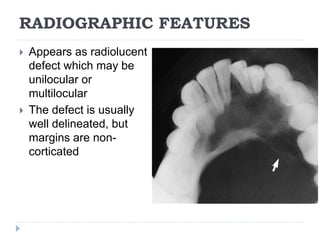 RADIOGRAPHIC FEATURES
 Appears as radiolucent
defect which may be
unilocular or
multilocular
 The defect is usually
well delineated, but
margins are non-
corticated
 
