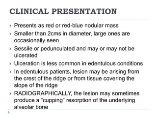 CLINICAL PRESENTATION
 Presents as red or red-blue nodular mass
 Smaller than 2cms in diameter, large ones are
occasionally seen
 Sessile or pedunculated and may or may not be
ulcerated
 Ulceration is less common in edentulous conditions
 In edentulous patients, lesion may be arising from
the crest of the ridge or from tissue covering the
slope of the ridge
 RADIOGRAPHICALLY, the lesion may sometimes
produce a “cupping” resorption of the underlying
alveolar bone
 