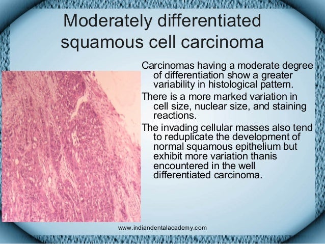 Malignant epithelial tumors ii/ dental implant courses