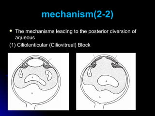 mechanism(2-2)
  The mechanisms leading to the posterior diversion of
   aqueous
(1) Ciliolenticular (Ciliovitreal) Block
 