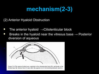 mechanism(2-3)
(2) Anterior Hyaloid Obstruction

    The anterior hyaloid →Ciliolenticular block
    Breaks in the hyaloid near the vitreous base → Posterior
    diversion of aqueous
 