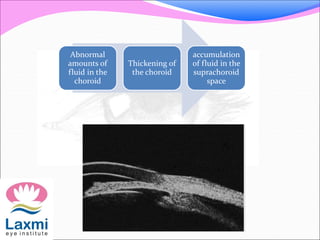 Abnormal 
amounts of 
fluid in the 
choroid 
Thickening of 
the choroid 
accumulation 
of fluid in the 
suprachoroid 
space 
 