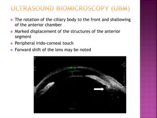  The rotation of the ciliary body to the front and shallowing
of the anterior chamber
 Marked displacement of the structures of the anterior
segment
 Peripheral irido-corneal touch
 Forward shift of the lens may be noted
 