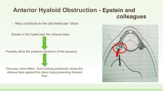 Anterior Hyaloid Obstruction - Epstein and
colleagues
• May contribute to the cilio-lenticular block
Breaks in the hyalid near the vitreous base.
Possibly allow the posterior diversion of the aqueous
One-way valve effect : fluid coming posteriorly closes the
vitreous face against the ciliary body,preventing forward
flow
 