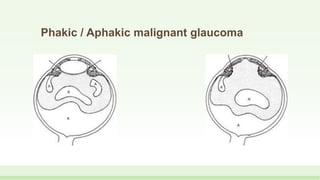 Phakic / Aphakic malignant glaucoma
 