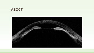 ASOCT
 