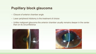 Pupillary block glaucoma
• Closure of anterior chamber angle
• Laser peripheral iridotomy is the treatment of choice
• Unlike malignant glaucoma the anterior chamber usually remains deeper in the center
than on its circumference
 