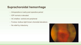 Suprachoroidal hemorrhage
• Introperative or early post operative period
• IOP normal or elevated
• AC shallow- central and peripheral
• Fundus- bullous light brown choroidal elevations
• No relief by iridectomy
 