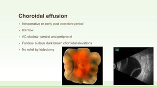 Choroidal effusion
• Introperative or early post operative period
• IOP low
• AC shallow- central and peripheral
• Fundus- bullous dark brown choroidal elevations
• No relief by iridectomy
 