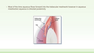 • Most of the time aqueous flows forward into the trabecular meshwork however in aqueous
misdirection aqueous is directed posteriorly
 