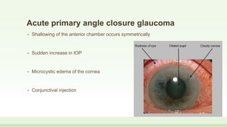 Acute primary angle closure glaucoma
• Shallowing of the anterior chamber occurs symmetrically
• Sudden increase in IOP
• Microcystic edema of the cornea
• Conjunctival injection
 