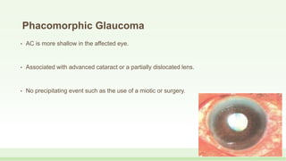 Phacomorphic Glaucoma
• AC is more shallow in the affected eye.
• Associated with advanced cataract or a partially dislocated lens.
• No precipitating event such as the use of a miotic or surgery.
 