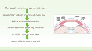 Many possible mechanisms in aqueous misdirection
contact of ciliary body with lens and/or ant. hyaloid face
blockage at the level of ciliary sulcus
aqueous then flow the easiest way - Posteriorly
ant. Hyaloid act as a one way valve
trapping fluid in the posterior segment
 