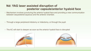 Nd: YAG laser assisted disruption of
posterior capsule/anterior hyaloid face
• Mechanism involves puncturing the anterior hyaloid face and providing a new communication
between sequestered aqueous and the anterior chamber.
• Through a large peripheral iridotomy or iridectomy, or through the pupil.
• The AC will start to deepen as soon as the anterior hyaloid face is disrupted
 