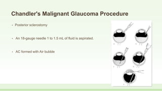 Chandler's Malignant Glaucoma Procedure
• Posterior sclerostomy
• An 18-gauge needle 1 to 1.5 mL of fluid is aspirated.
• AC formed with Air bubble
 