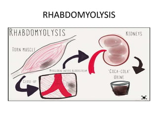 RHABDOMYOLYSIS
 