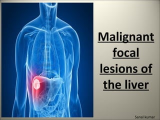 Malignant
focal
lesions of
the liver
Sanal kumar
 