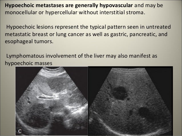 Focal malignant lesions of the liver.