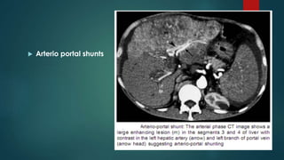  Arterio portal shunts
 