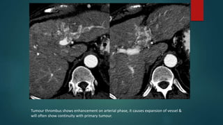 Tumour thrombus shows enhancement on arterial phase, it causes expansion of vessel &
will often show continuity with primary tumour.
 
