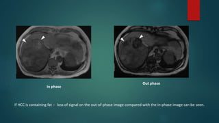In phase
Out phase
If HCC is containing fat :- loss of signal on the out-of-phase image compared with the in-phase image can be seen.
 