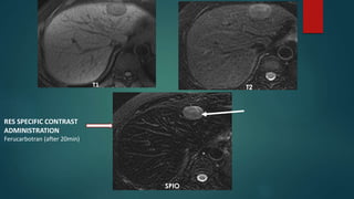 T1 T2
SPIO
RES SPECIFIC CONTRAST
ADMINISTRATION
Ferucarbotran (after 20min)
 