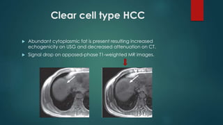 Clear cell type HCC
 Abundant cytoplasmic fat is present resulting increased
echogenicity on USG and decreased attenuation on CT.
 Signal drop on opposed-phase T1-weighted MR images.
 