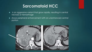 Sarcomatoid HCC
 is an aggressive variant that grow rapidly, resulting in central
necrosis or hemorrhage
 shows peripheral enhancement with an unenhanced central
portion
 