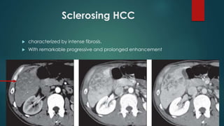 Sclerosing HCC
 characterized by intense fibrosis.
 With remarkable progressive and prolonged enhancement
 