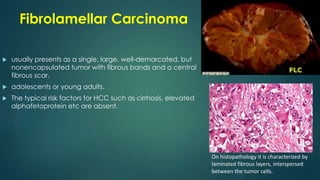 Fibrolamellar Carcinoma
 usually presents as a single, large, well-demarcated, but
nonencapsulated tumor with fibrous bands and a central
fibrous scar.
 adolescents or young adults.
 The typical risk factors for HCC such as cirrhosis, elevated
alphafetoprotein etc are absent.
On histopathology it is characterized by
laminated fibrous layers, interspersed
between the tumor cells.
 